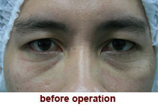 plastic-surgery-blepharoplasty